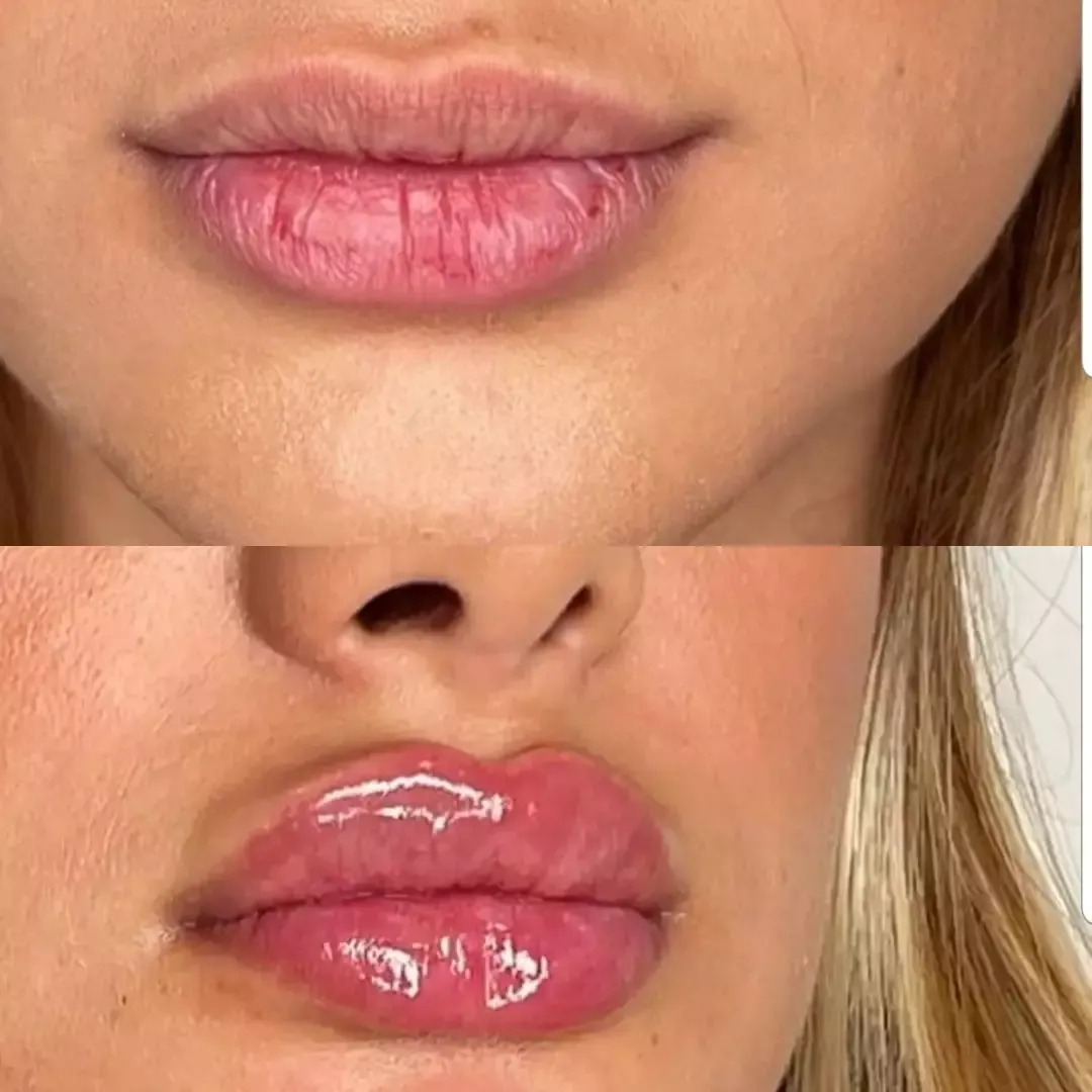 Fillers behandling före och efter i Täby