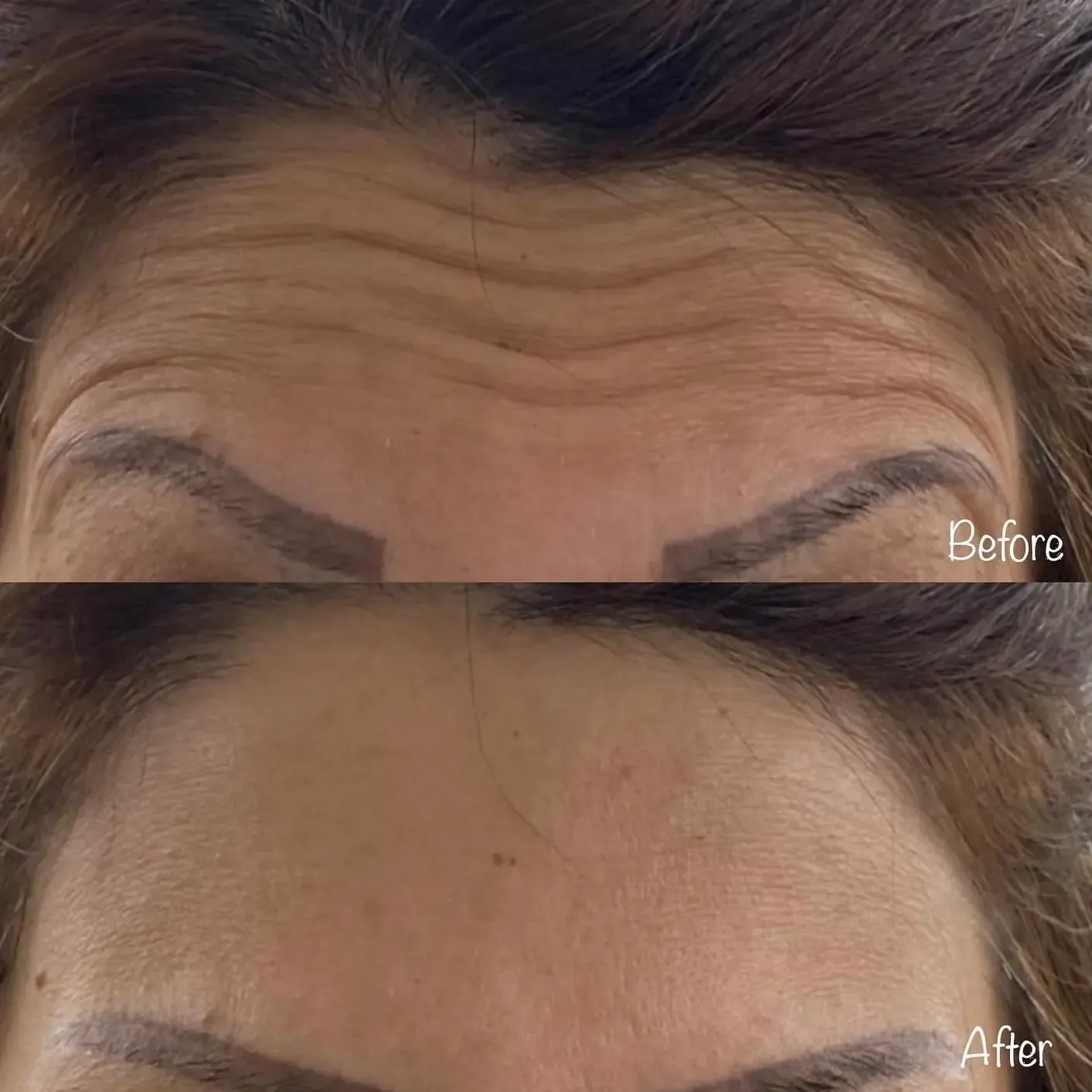 Botox resultat före och efter i Täby